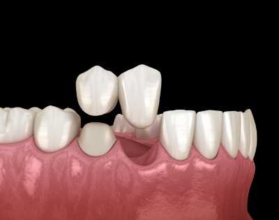 Animated smile during Cantilever dental bridge placement