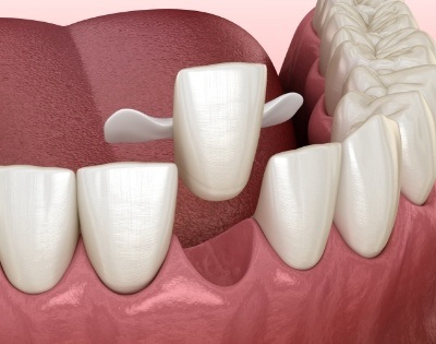 Animated smile during Maryland dental bridge placement