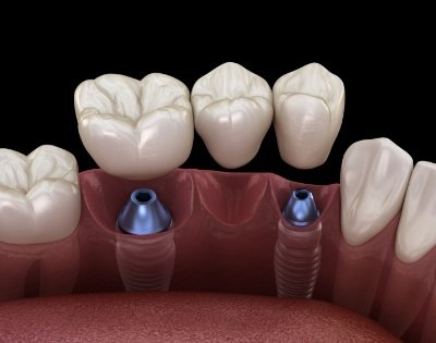 Animated smile during dental implant supported dental bridge placement