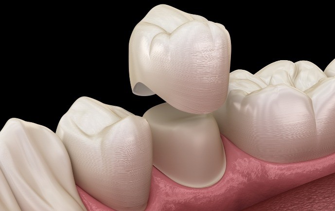 Animated smile during dental crown restorative dentistry treatment