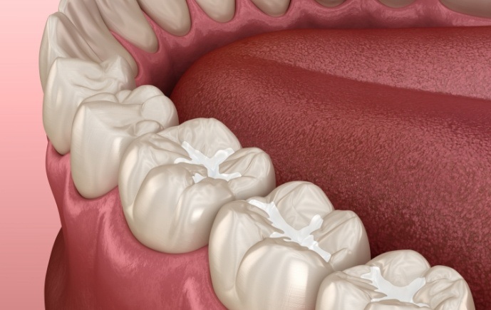 Animated smile with tooth colored fillings