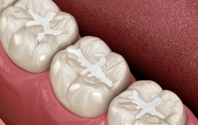 Animated smile with dental sealants