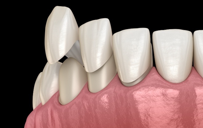 Animated smile during cosmetic dental bonding treatment