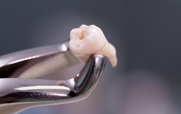 Metal clasp holding an extracted tooth