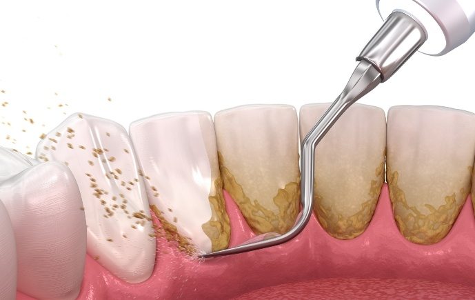 Animated smile during scaling and root planing treatment