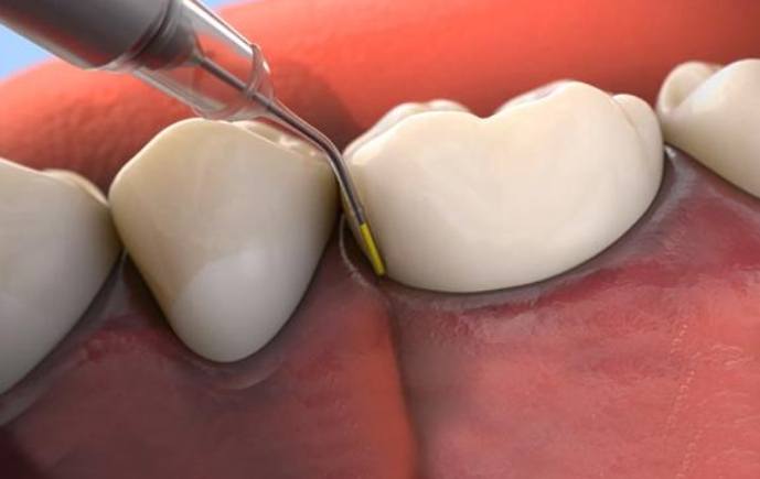 Animated smile during Arestin antibiotic therapy