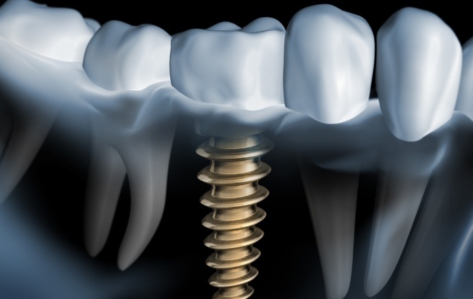 Animated smile with dental implant supported dental crown