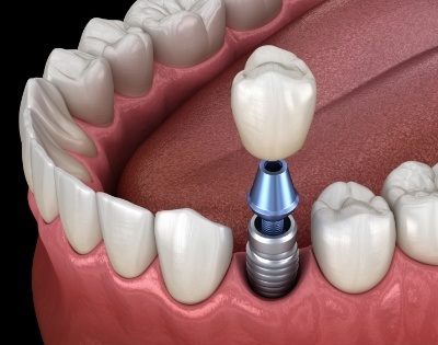 Animated smile during dental implant supported dental crown placement