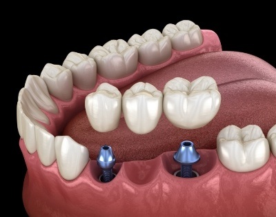 Animated smile during dental implant supported fixed bridge placement