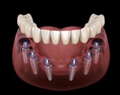 Animated smile during dental implant supported denture placement