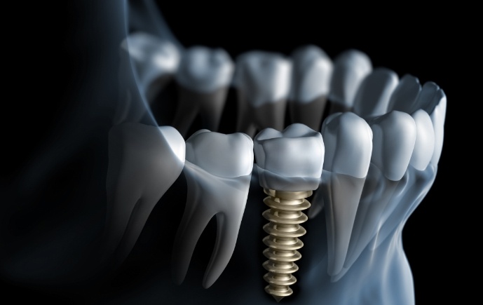 Animated smile with dental implant supported dental crown