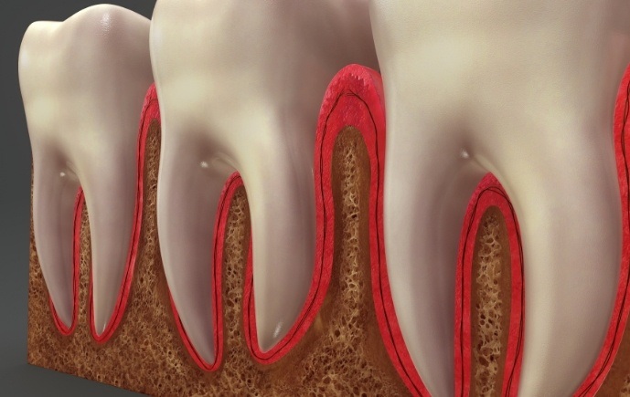 Animated smile with damaged gum tissue