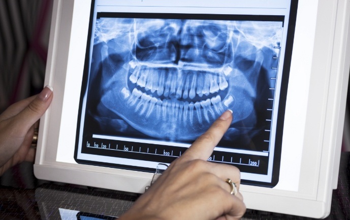 Digital dental x-rays on chairside computer monitor