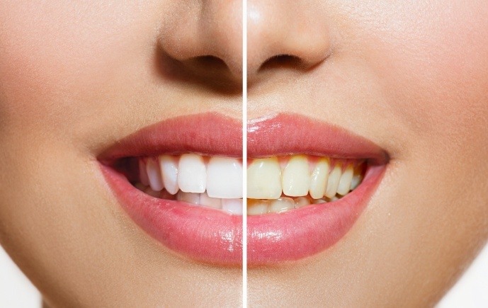 Smile before and after teeth whitening